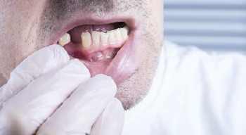 dentist placing tooth on prosthetic jaw