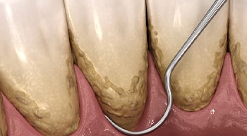 computer illustration of a dental scaler clearing plaque from teeth