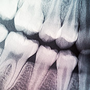 x-ray of teeth