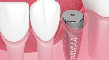 Digital illustration of a dental implant