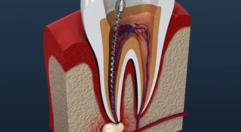 3D model of a root canal procedure