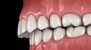 Illustration of an overbite
