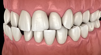 Illustration of a crossbite