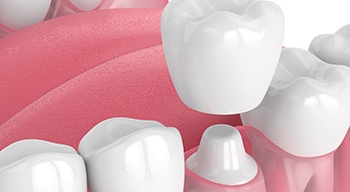 a 3d illustration of dental crown placement