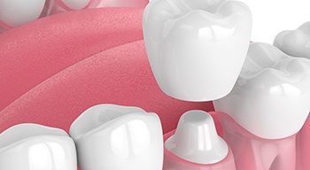 A diagram of a dental bridge.