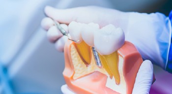 dentist placing tooth on prosthetic jaw