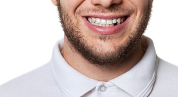 closeup of man smiling with missing tooth 