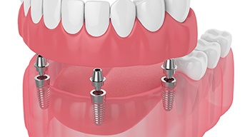 Digital illustration of implant dentures in Somerville