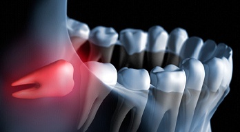 Image of an impacted wisdom tooth 