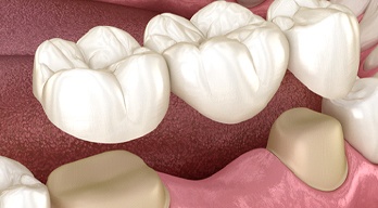 Digital image of a dental bridge  