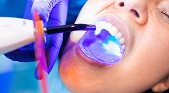a person having a dental filling cured