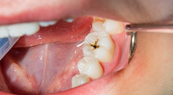 a person with a cavity on a tooth