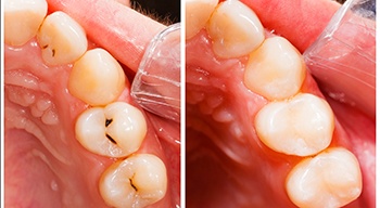 before and after getting a cavity filling
