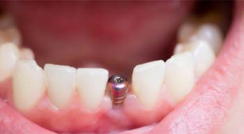 Patient with dental implants in Somerville