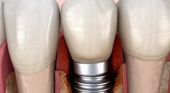 Illustration of a failed dental implant in Somerville, NJ