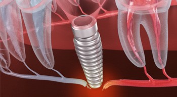 Render of a failed dental implant in Somerville, NJ
