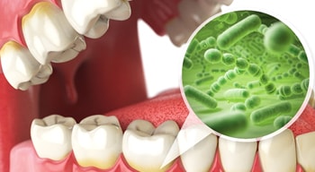 computer illustration of oral bacteria accumulation that requires periodontal therapy