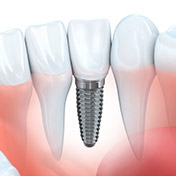 illustration of implant