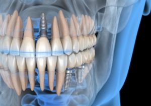 computer model of dental implants holding restorations in place