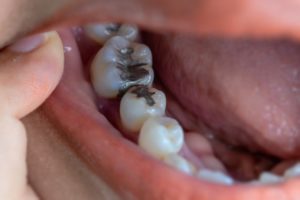 Metal fillings