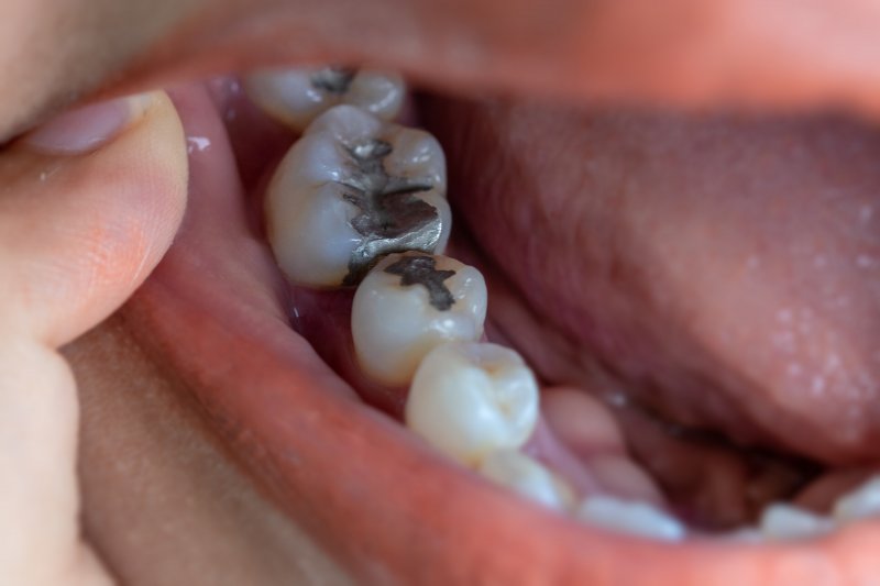 Are Metal Tooth Fillings Dangerous to Health?